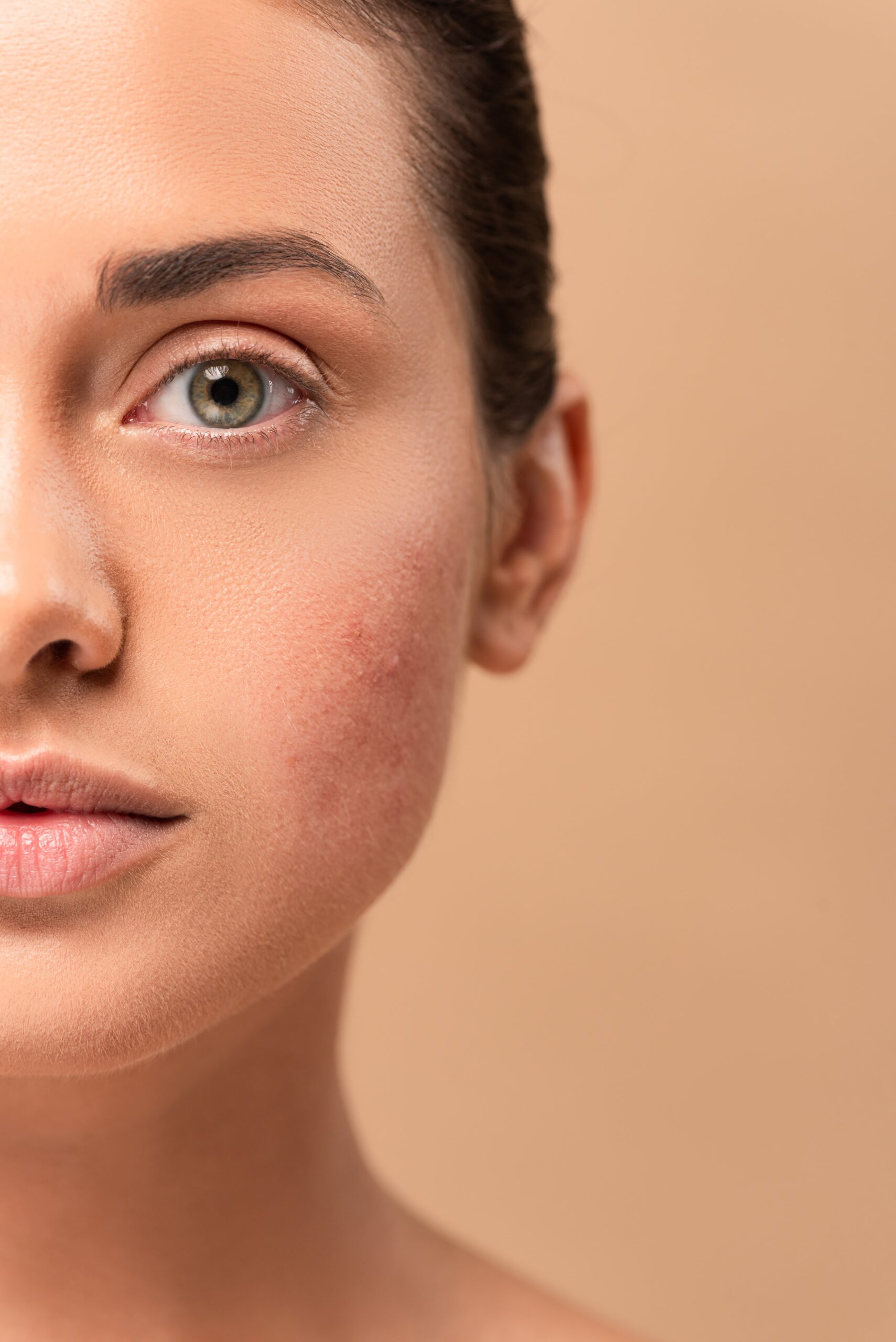 cropped-view-of-girl-with-problem-skin-looking-at-2024-11-18-03-23-57-utc-min cropped view of girl with problem skin looking at camera isolated on beige