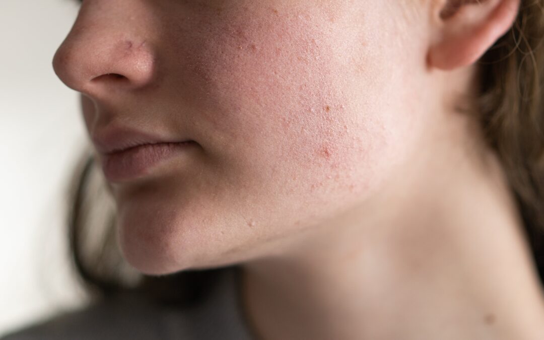How to Get Rid of Face Redness: Gentle Skincare and Pro Tips