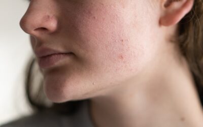 How to Get Rid of Face Redness: Gentle Skincare and Pro Tips