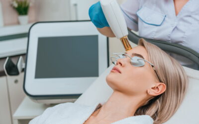 BBL Laser for Rosacea